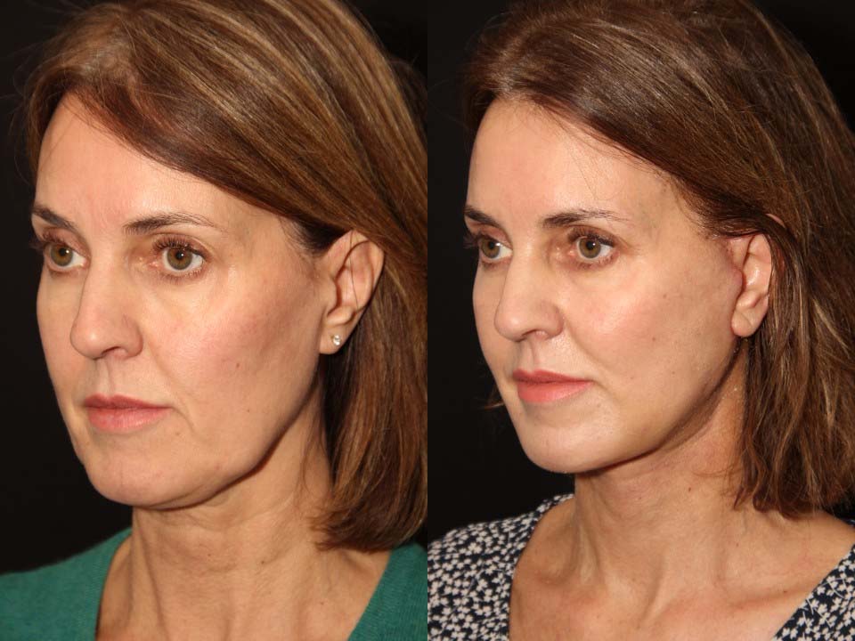 FACE LIFT AND NECK LIFT BEFORE AND AFTER TORONTO 1