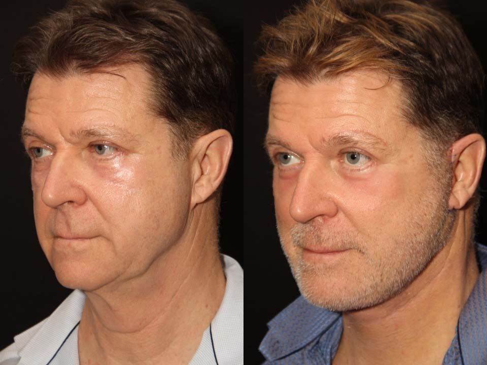 FACE LIFT AND NECK LIFT BEFORE AND AFTER TORONTO 2