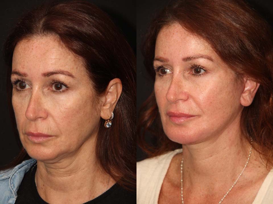 FACE LIFT AND NECK LIFT BEFORE AND AFTER TORONTO 1
