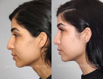 persian rhinoplasty toronto dr philip solomon