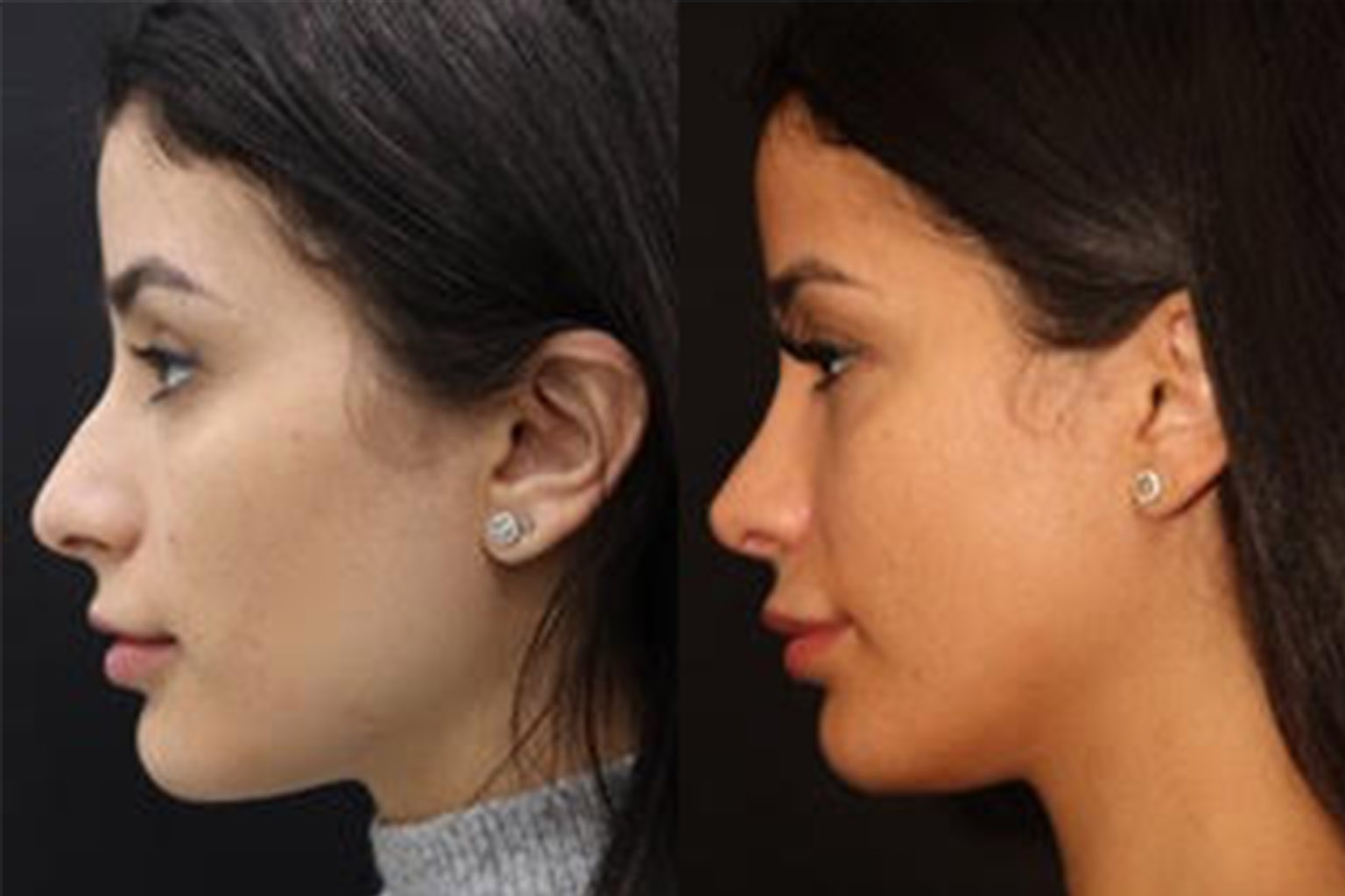 Rhinoplasty Toronto before and after