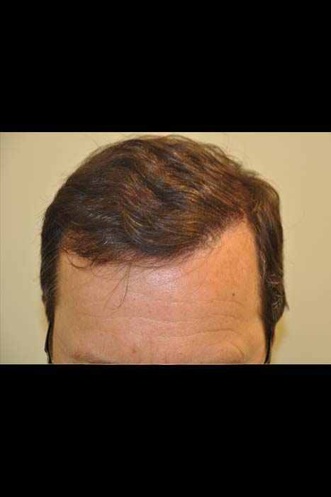 Hair transplant Treatment after 1
