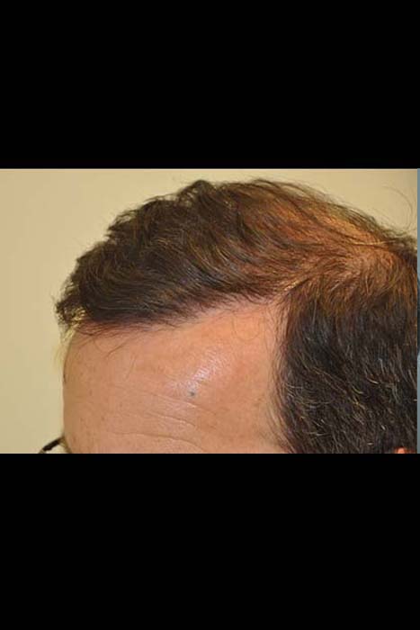 Hair transplant Treatment after 2