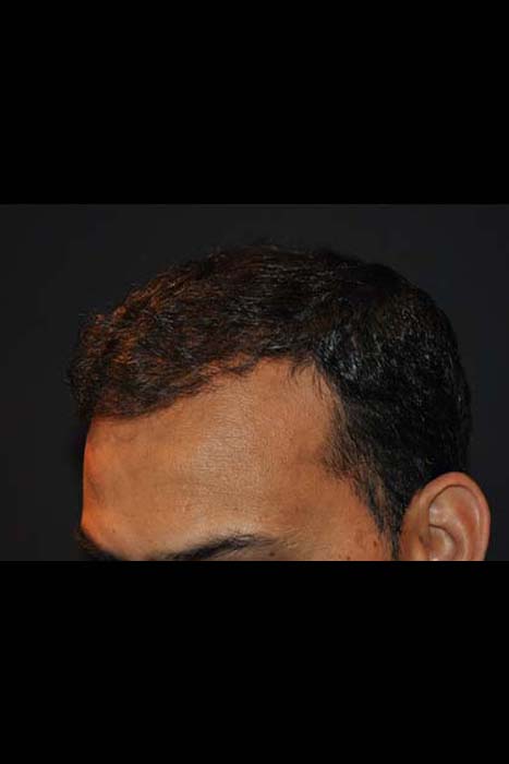 After Hair transplant 1