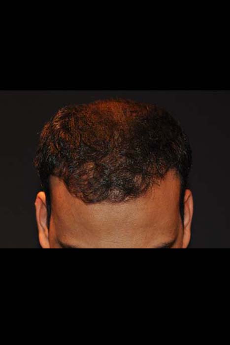 Hair transplant after 2