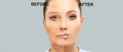 BEFORE & AFTER YOUR BOTOX TREATMENT