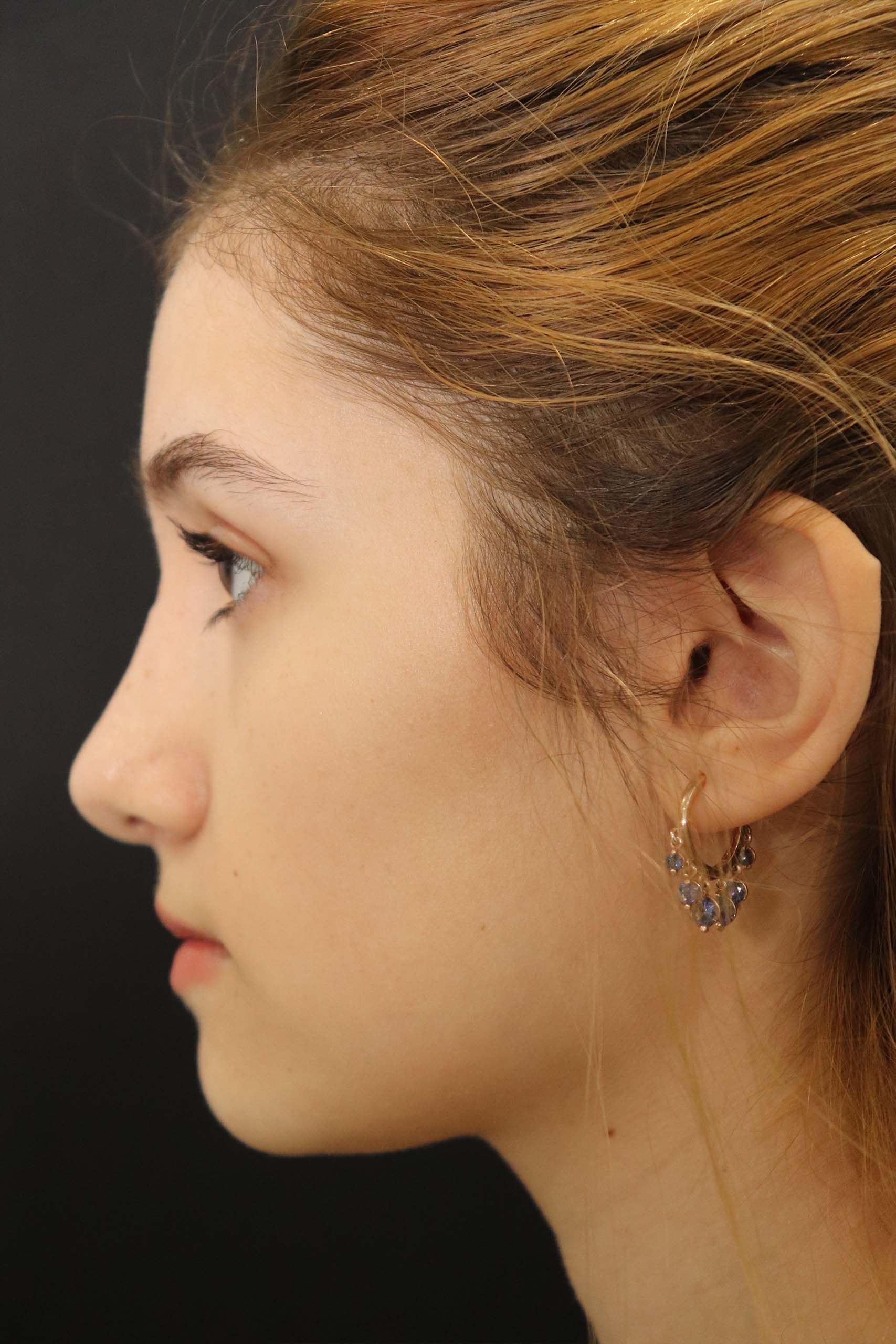 Nasal Tip Rhinoplasty Surgery After