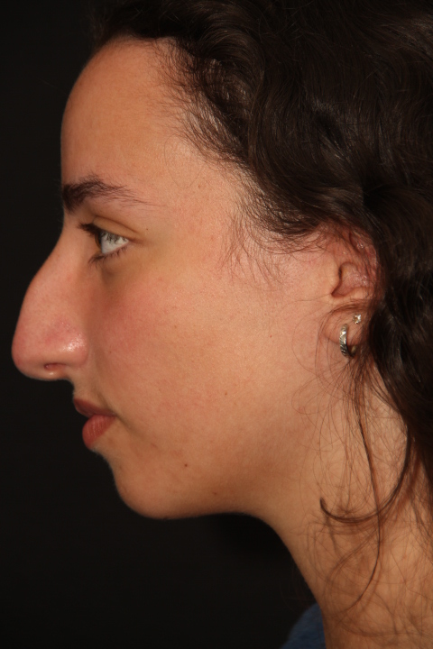 Female Reductive Rhinoplasty Surgery Before