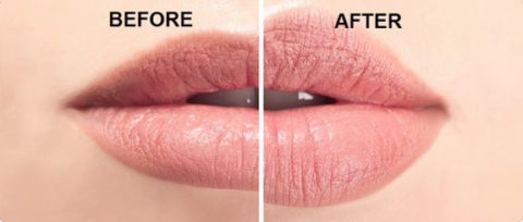 Before & After your Filler Treatment