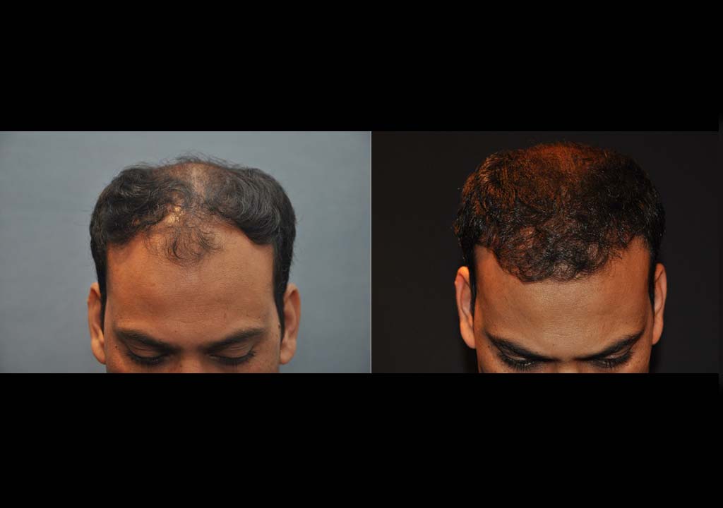 Hair transplant Before & After 1