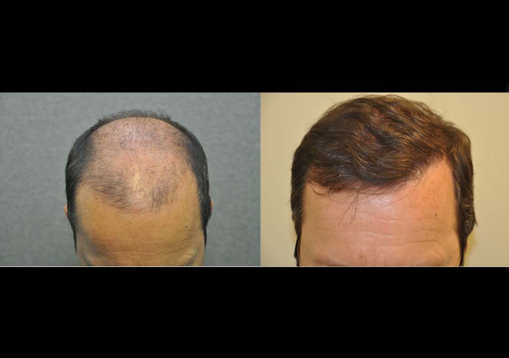 Hair transplant Before & After 2
