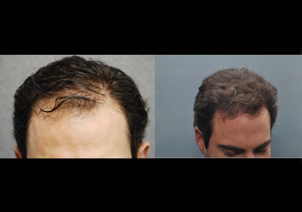 Hair transplant Before & After 3