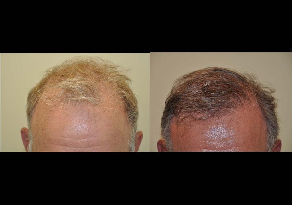 Hair transplant Before & After 4