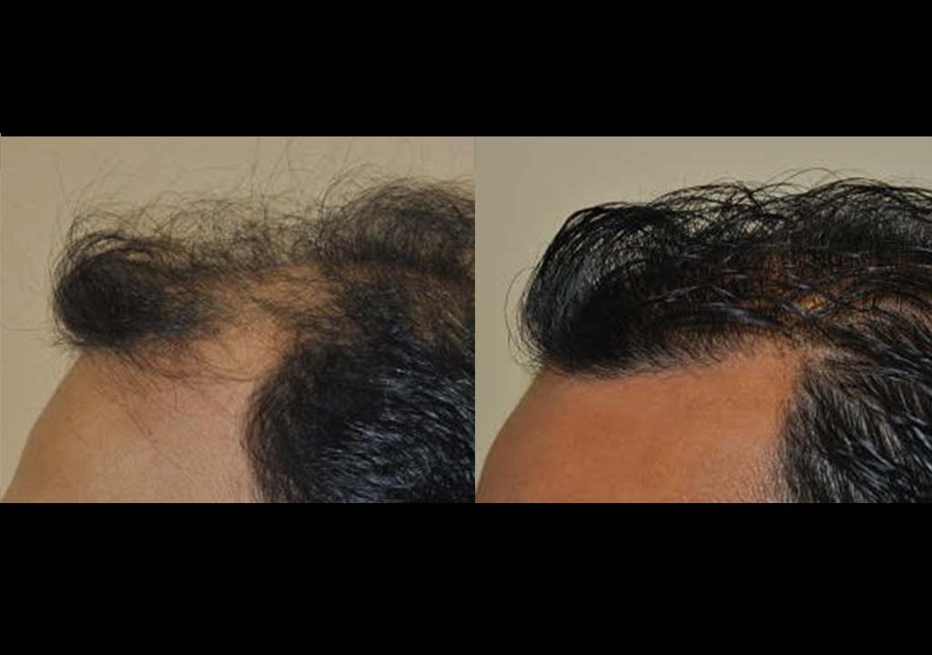 Hair Transplant Before & After