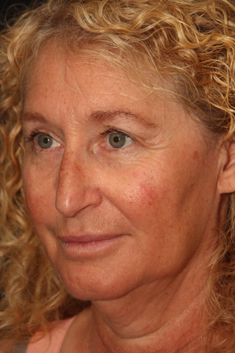 Facelift Surgery Before After Photos