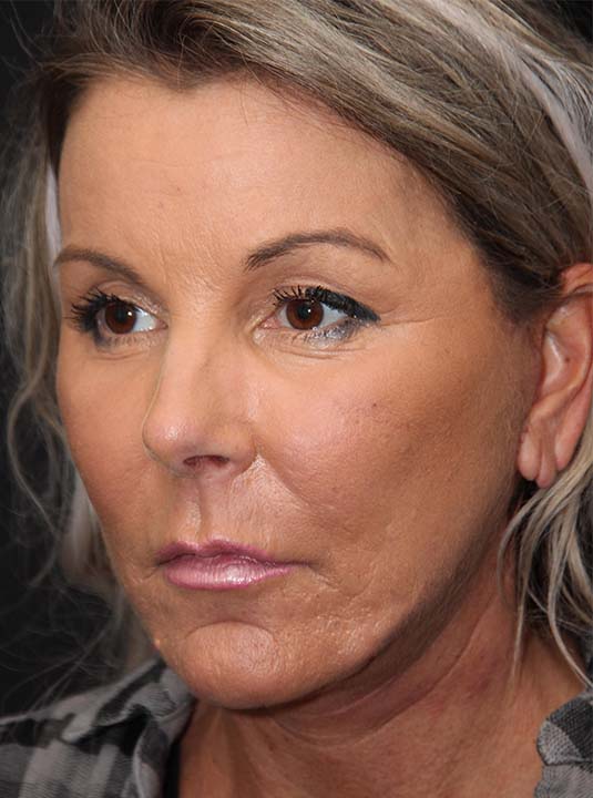 Laser Resurfacing Before and After Photos