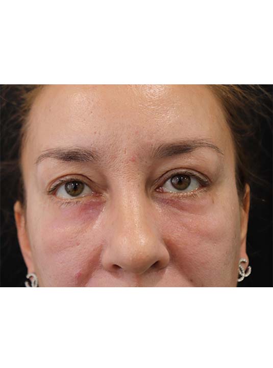 Lower Blepharoplasty With CO2 Laser Before and After Photos