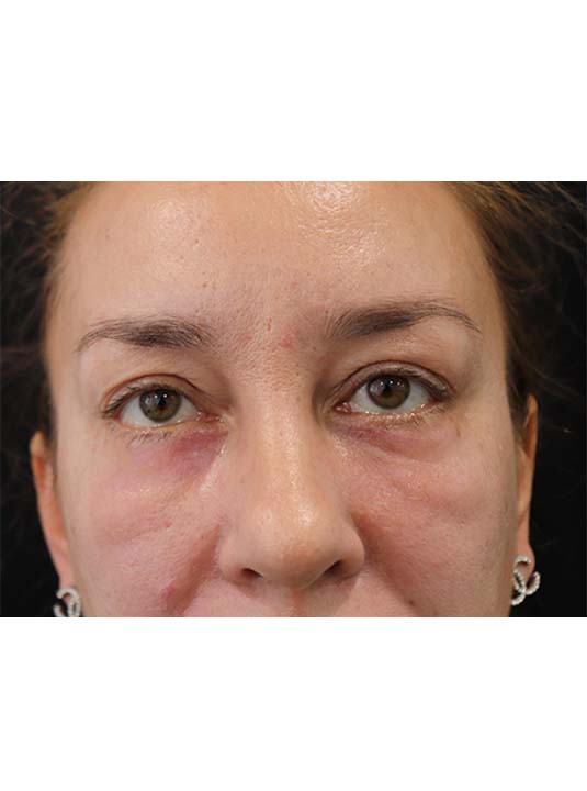 Blepharoplasty Before and After Photos