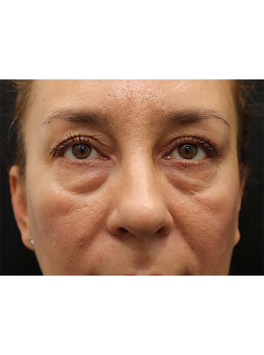Lower Blepharoplasty With CO2 Laser Before and After Photos