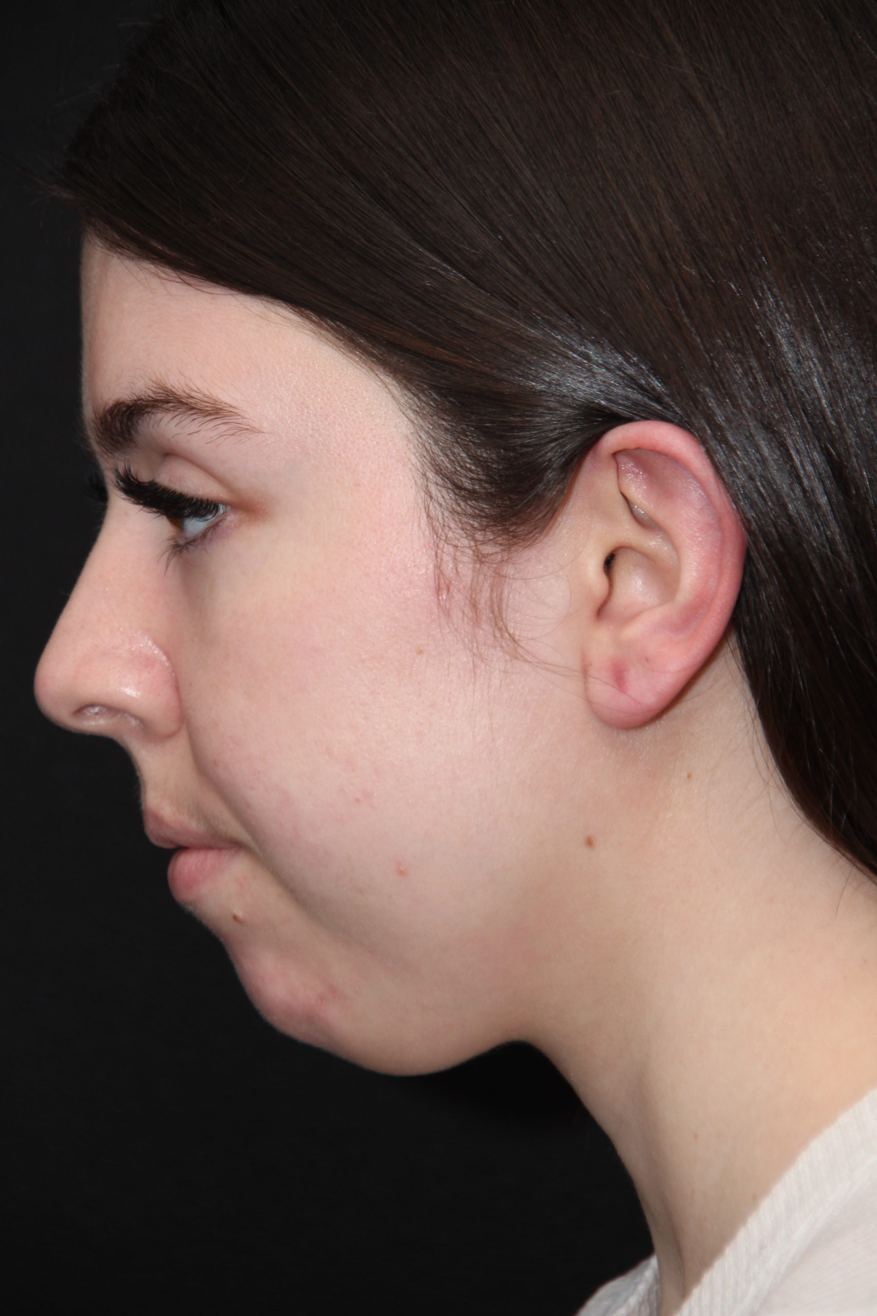 Chin Implant Surgery Before and After Photos