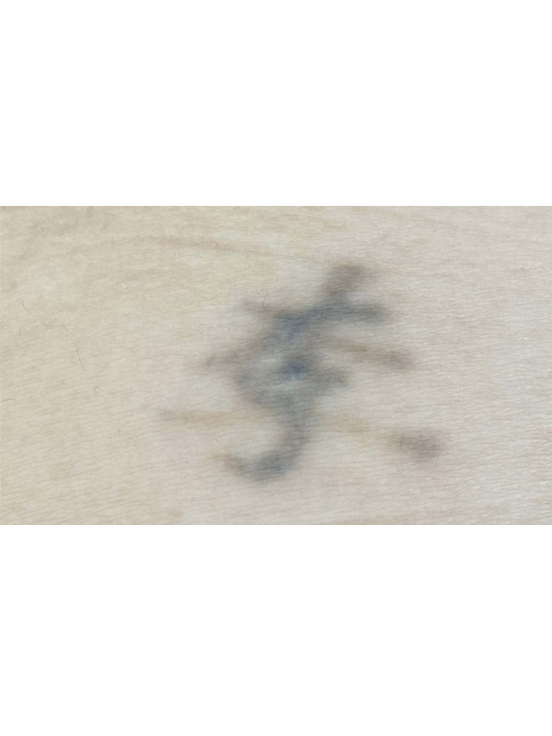 Tattoo Removal Before and After Photos