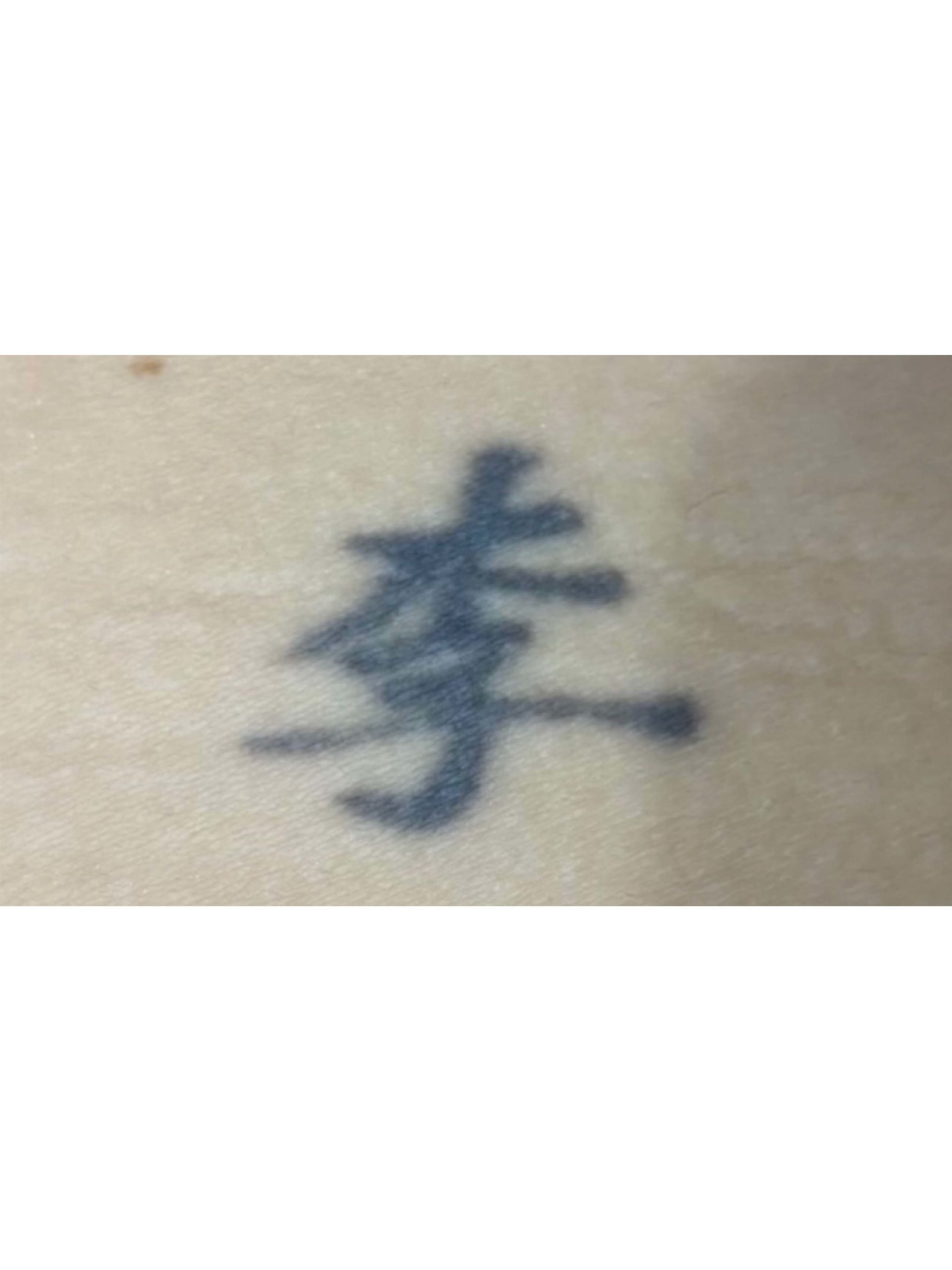 Tattoo Removal Before and After Photos