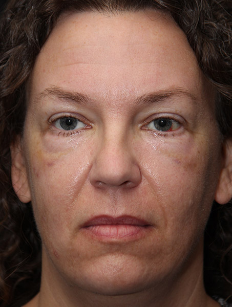 Blepharoplasty Before and After Photos