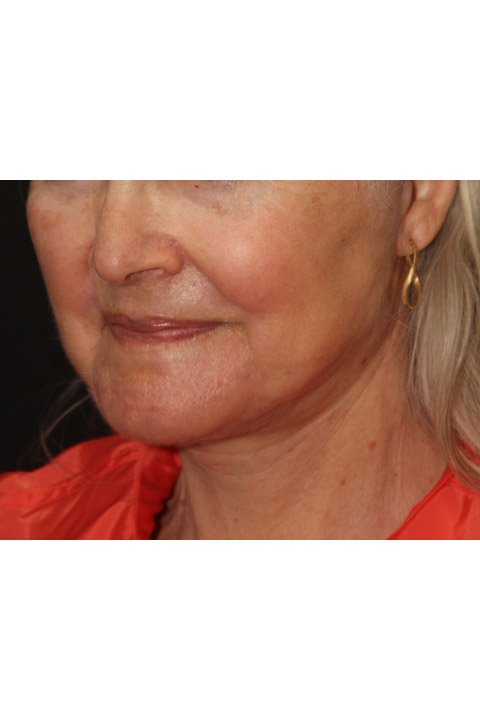 Laser Resurfacing Before and After Photos