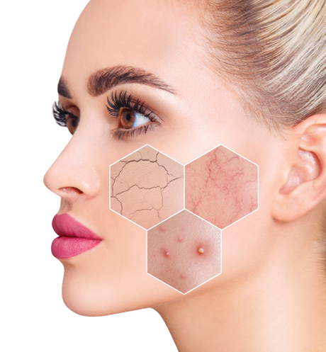 Rosacea / Facial Veins Treatments With Solomon Facial Plastic