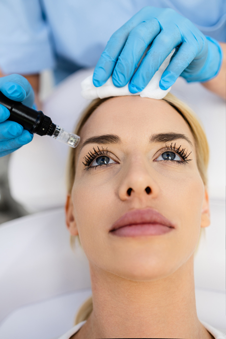 microneedling and radio-frequency Treatments 
