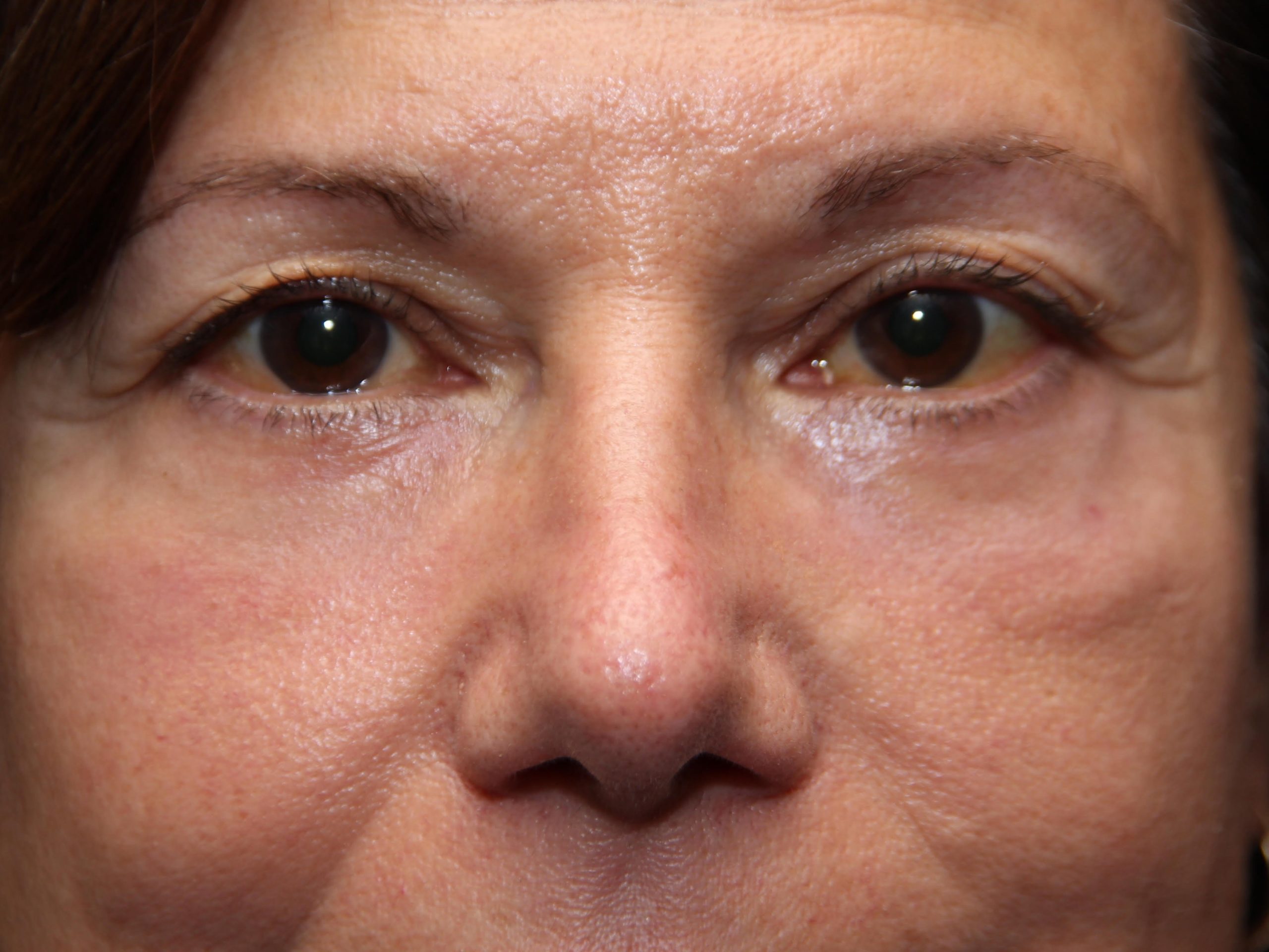 Blepharoplasty Before and After Photos