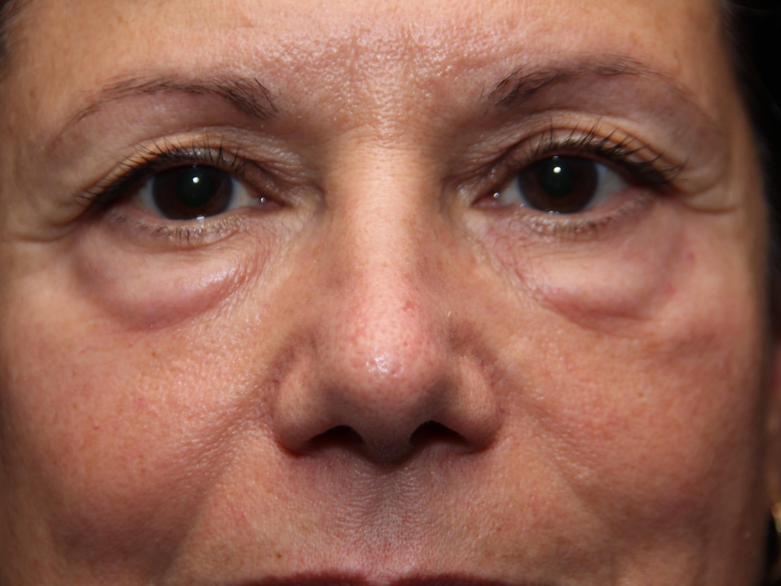 Blepharoplasty Before and After Photos