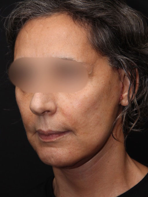 Facelift Surgery Before After Photos