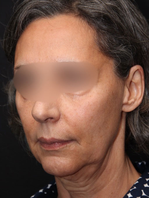 Facelift Surgery Before After Photos