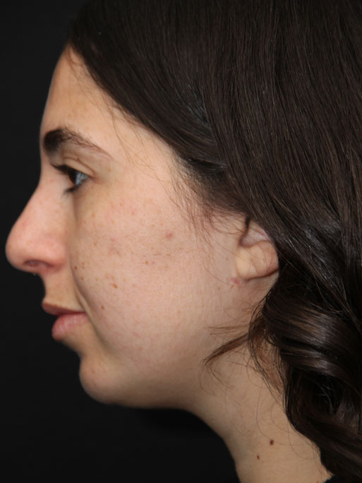 Chin Implant Surgery Before and After Photos