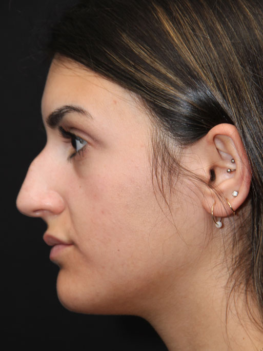 Reductive Rhinoplasty Surgery Before