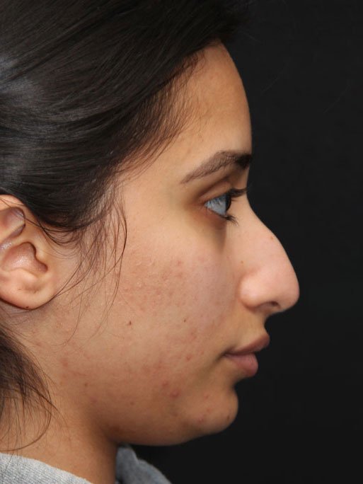 Closed Rhinoplasty Before