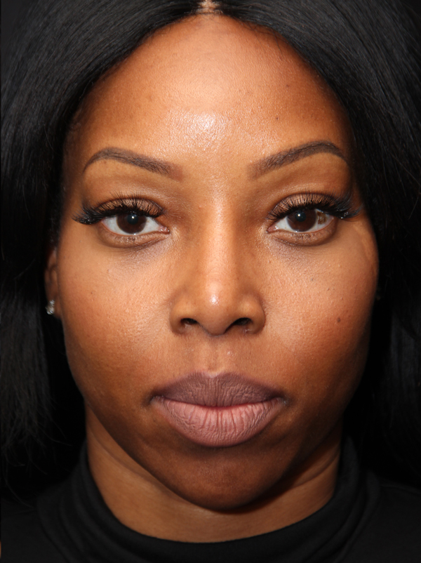Non Caucasian African American Rhinoplasty Patient After