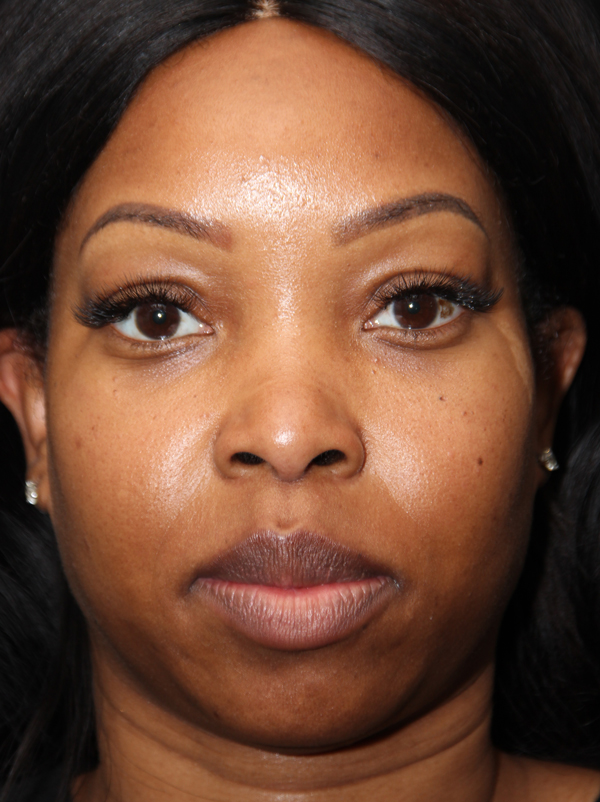 Non Caucasian African American Rhinoplasty Patient Before