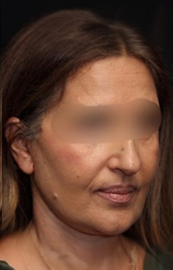Lower facelift and Neck Lift surgery Before and After Photos