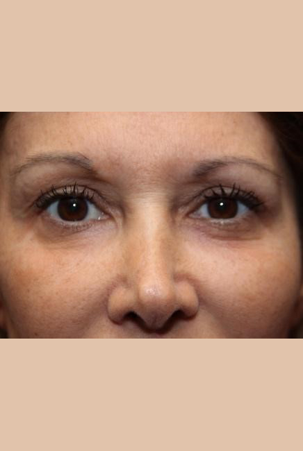 Laser Resurfacing Before and After Photos