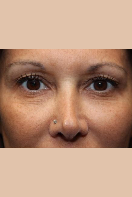 Laser Resurfacing Before and After Photos