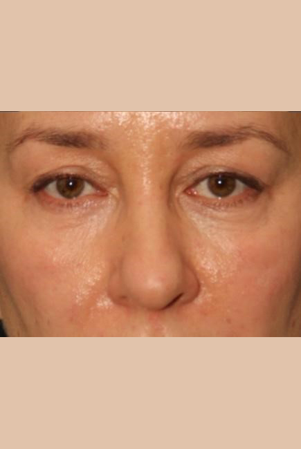 Laser Resurfacing Before and After Photos