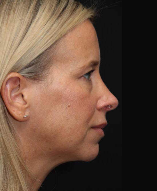 Closed Rhinoplasty with Dr. Philip Solomon After