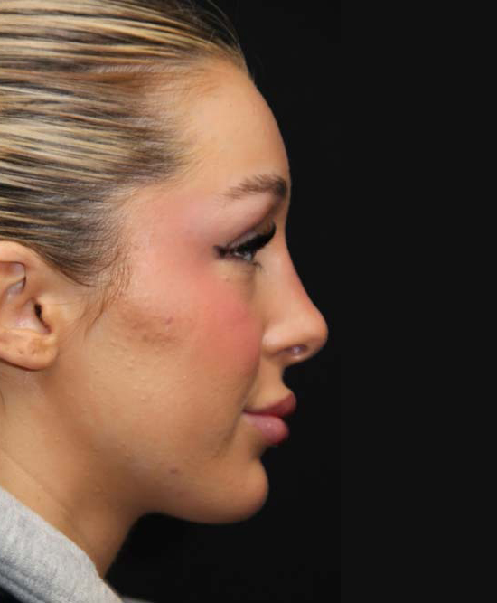 Reductive Rhinoplasty After