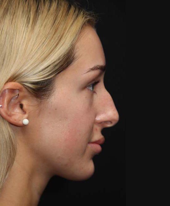 Reductive Rhinoplasty Before
