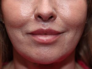 Lip Lift Surgery in Toronto