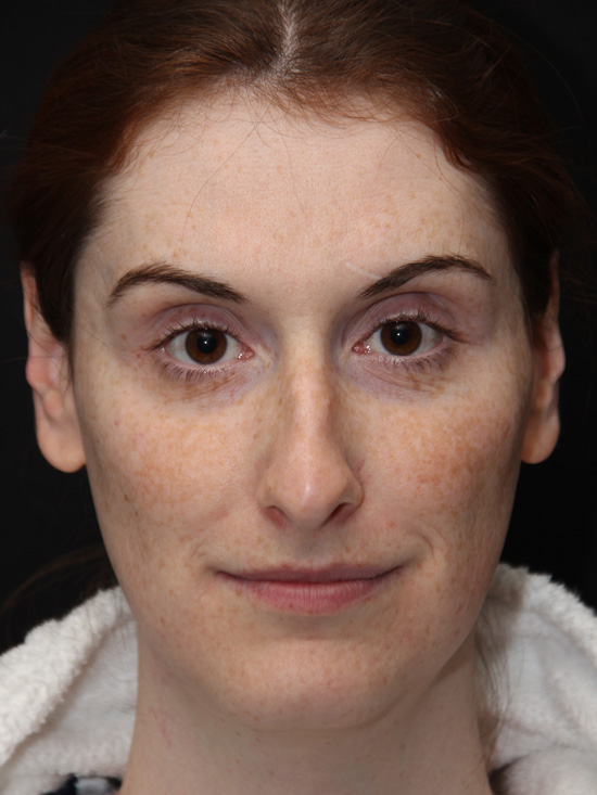 Facial Feminization Surgery Before and After Photos