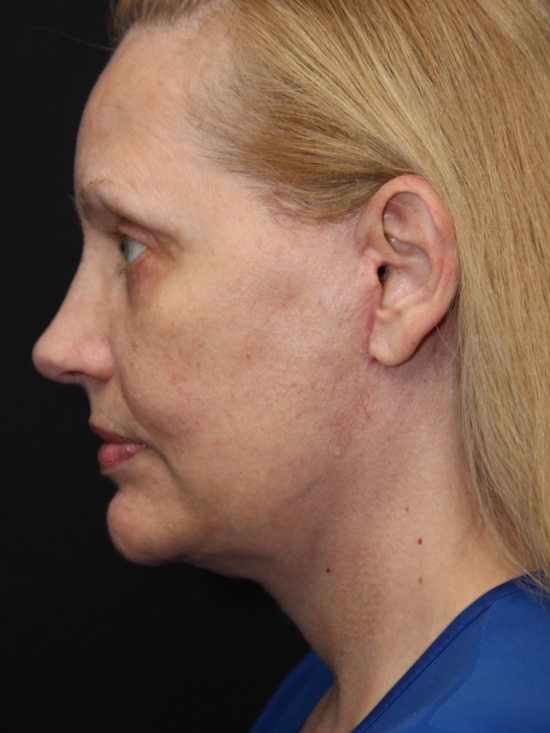 Before and After Vertical Deep Plane Facelift