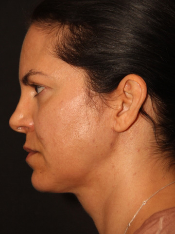 Facetite and Neck Liposuction Before and After Photos